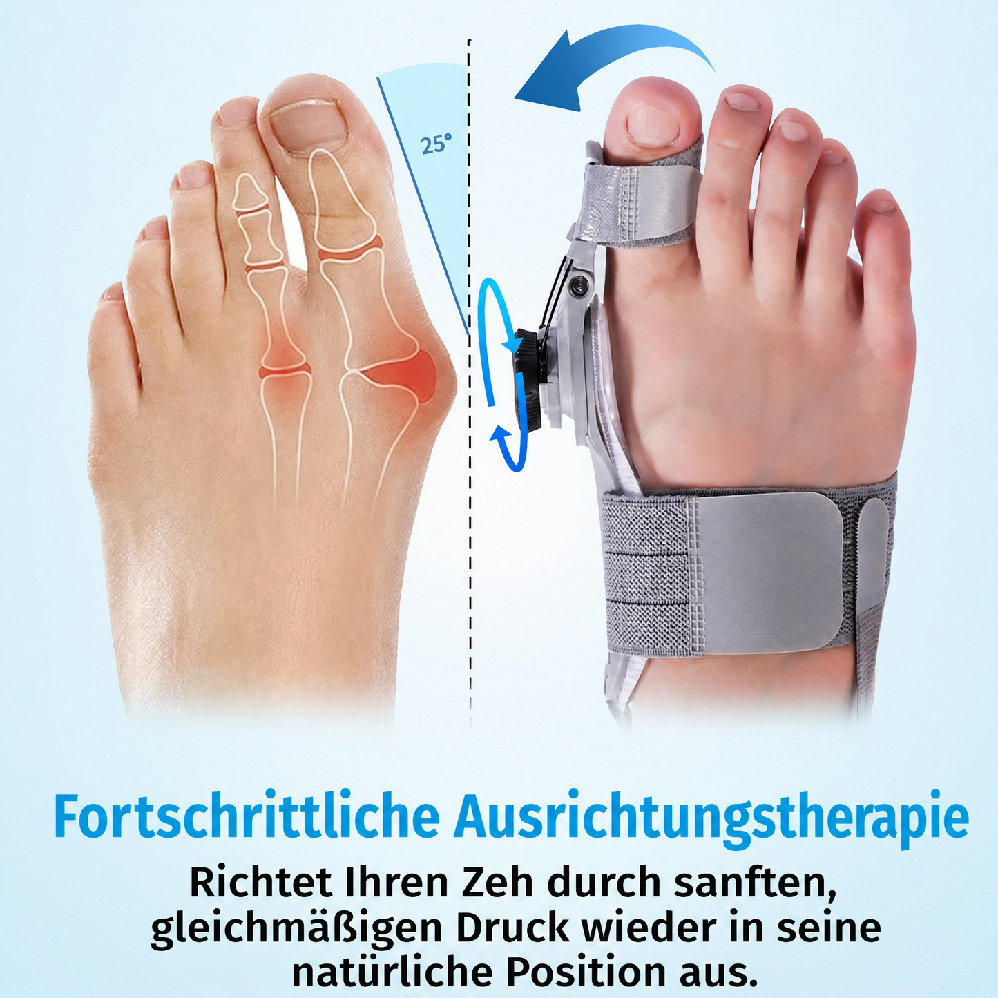 Orthomedy Bunion Fix